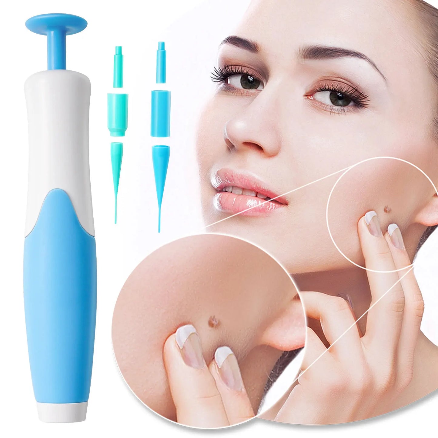 Skin Tag Removal Kit - Smart Shop (Online Store for wise shoppers) 