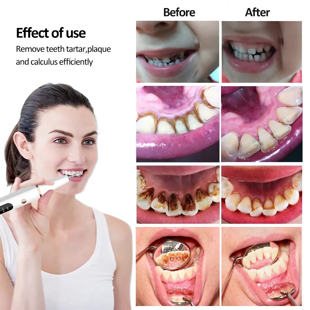 Electric Dental Calculus Remover - Smart Shop (Online Store for wise shoppers) 