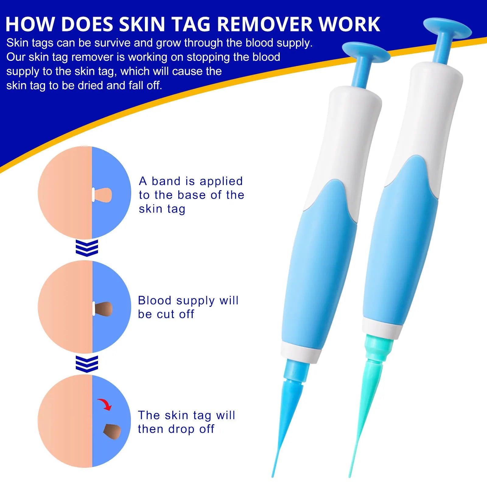 Skin Tag Removal Kit - Smart Shop (Online Store for wise shoppers) 