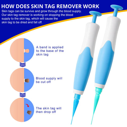 Skin Tag Removal Kit - Smart Shop (Online Store for wise shoppers) 