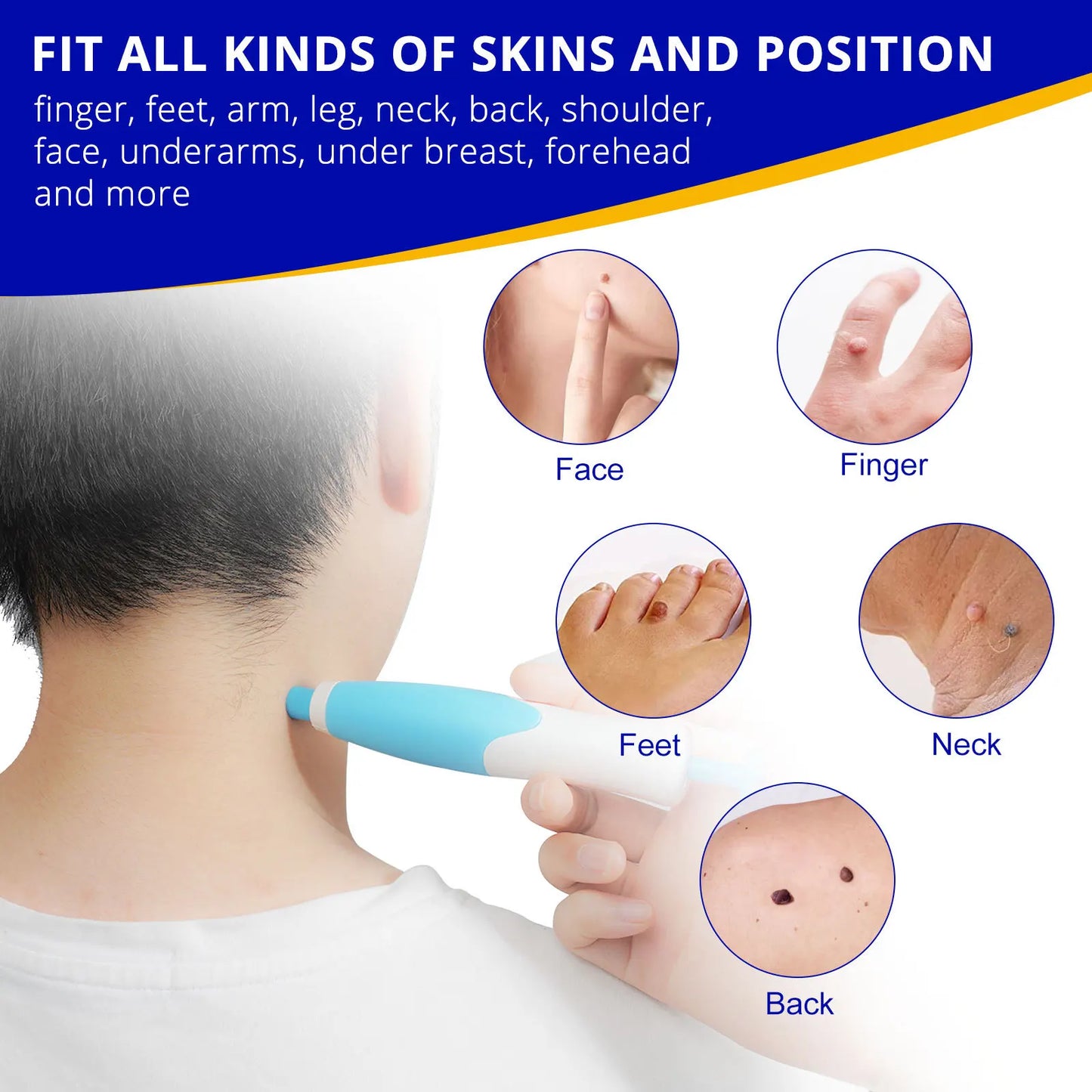 Skin Tag Removal Kit - Smart Shop (Online Store for wise shoppers) 