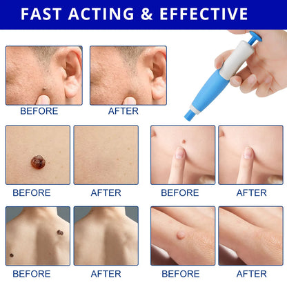 Skin Tag Removal Kit - Smart Shop (Online Store for wise shoppers) 