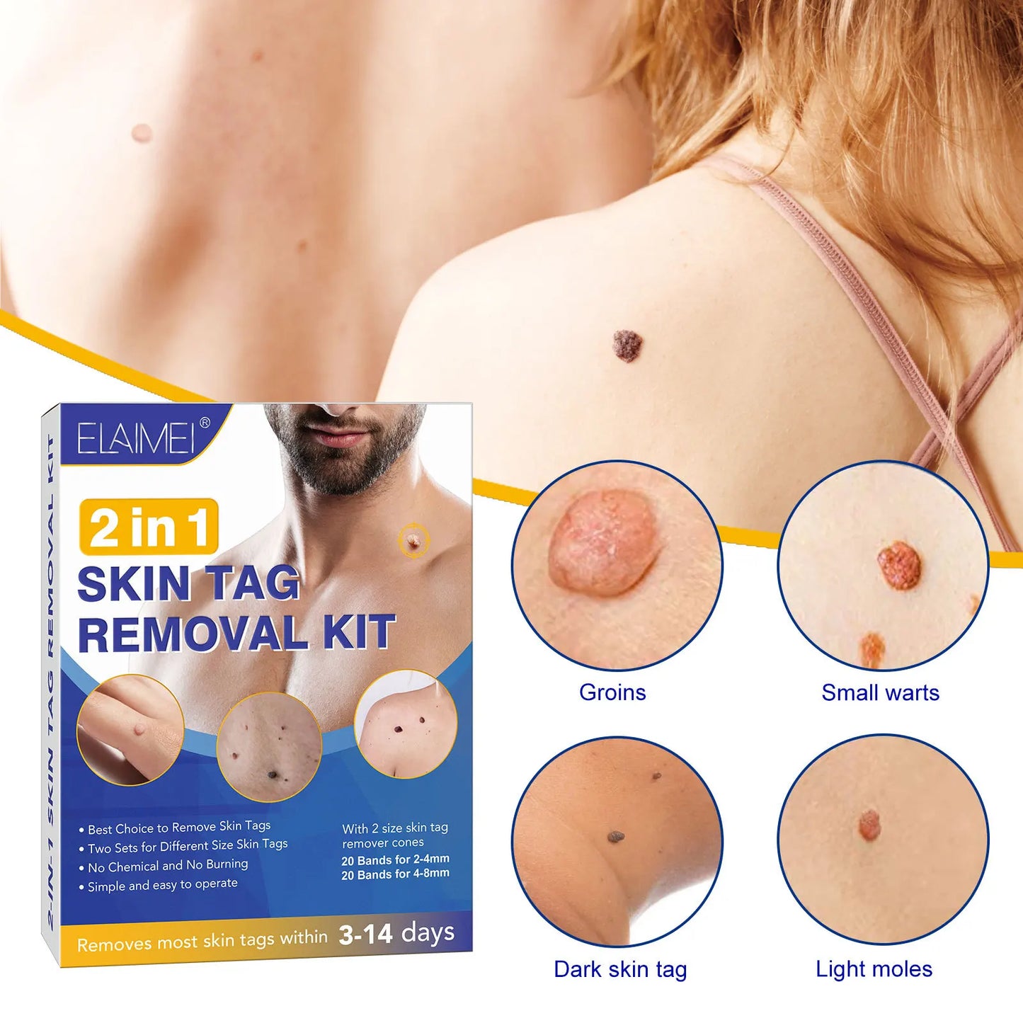 Skin Tag Removal Kit - Smart Shop (Online Store for wise shoppers) 