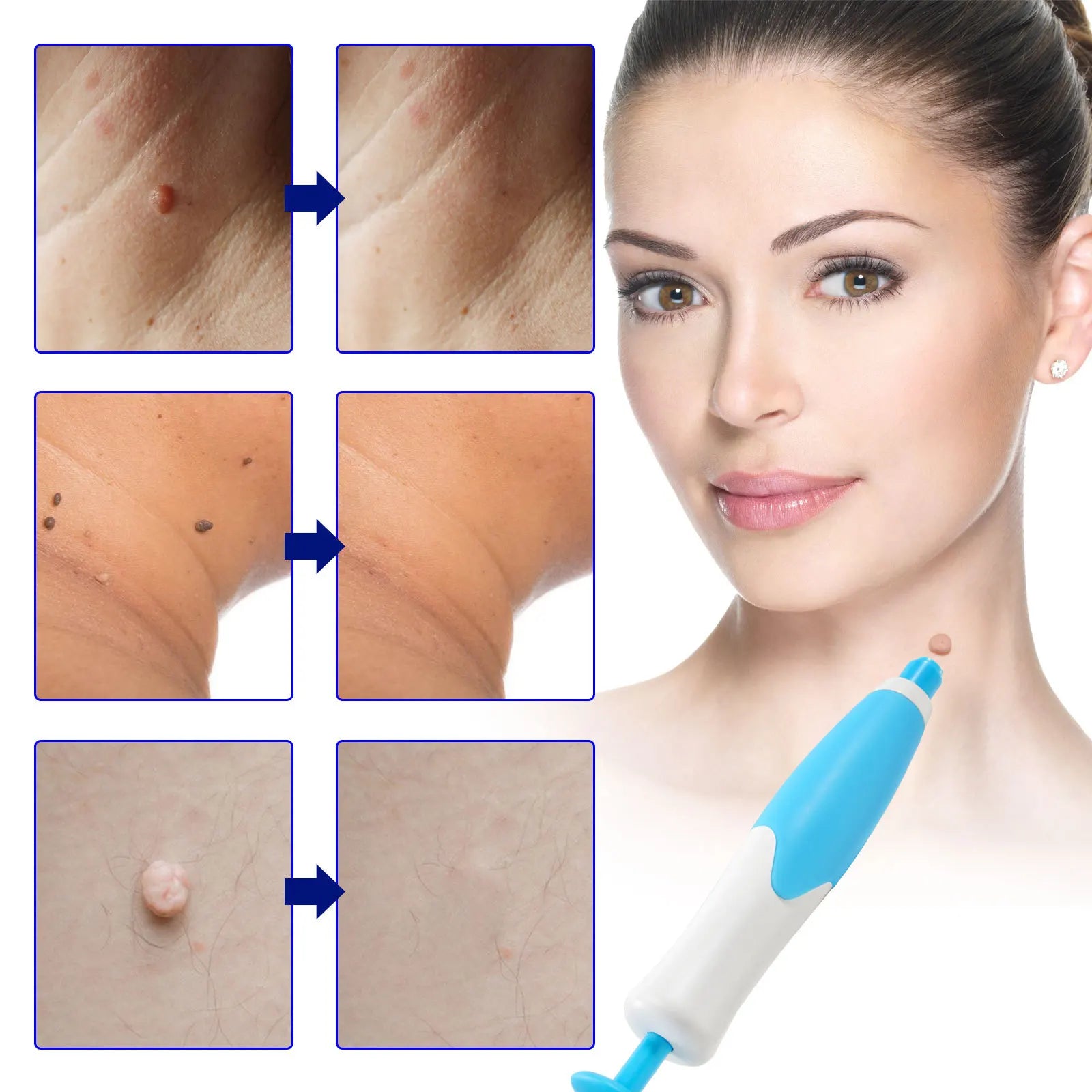 Skin Tag Removal Kit - Smart Shop (Online Store for wise shoppers) 