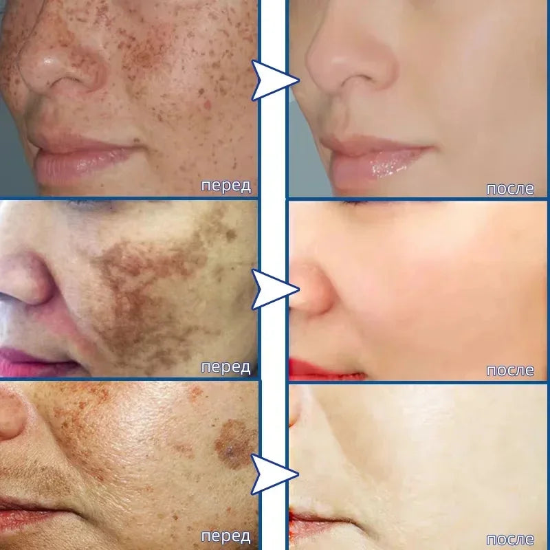 Moisturizing Dark Spots Remover - Smart Shop (Online Store for wise shoppers) 