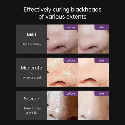 Cleanuest™ - Blackhead Remover Mask - Smart Shop (Online Store for wise shoppers) )