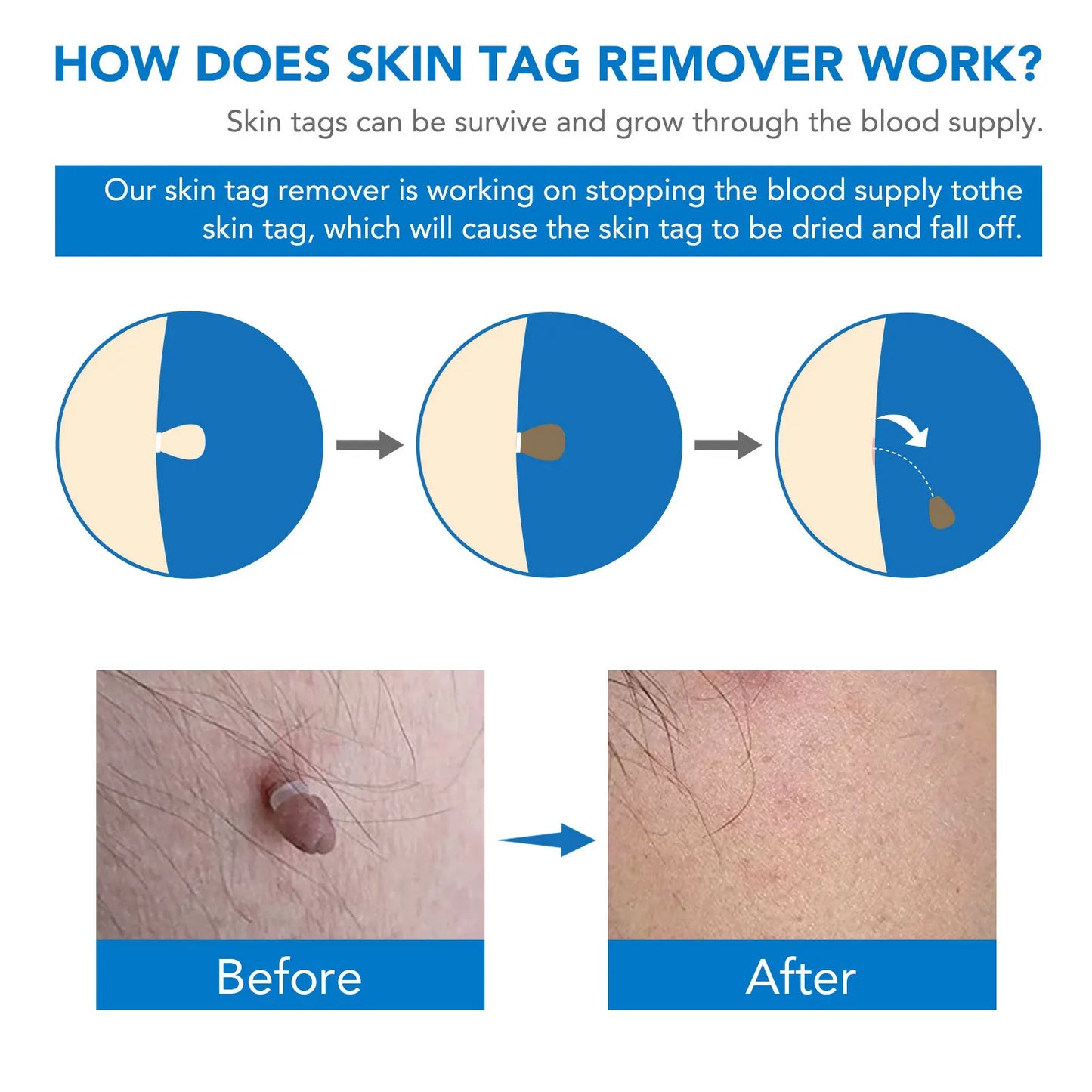 Skin Tag Removal Kit - Smart Shop (Online Store for wise shoppers) 