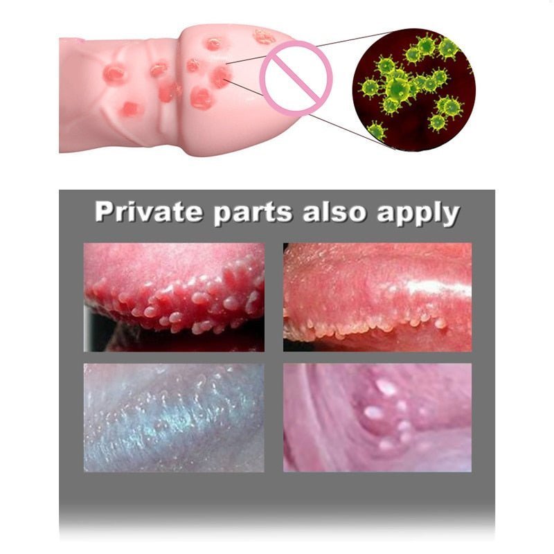 AntiWart™ - Painless Warts Solution - Smart Shop (Online Store for wise shoppers) )