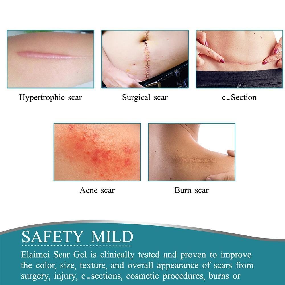 ELAIMEI™ Medical Soft Silicone Gel Tape for Scar Removal (1.6” x 60”） - Smart Shop (Online Store for wise shoppers) )