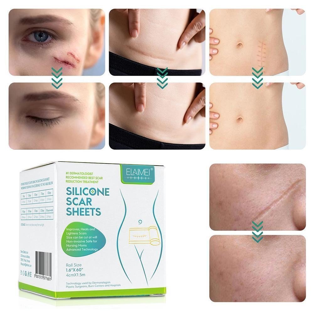 ELAIMEI™ Medical Soft Silicone Gel Tape for Scar Removal (1.6” x 60”） - Smart Shop (Online Store for wise shoppers) )