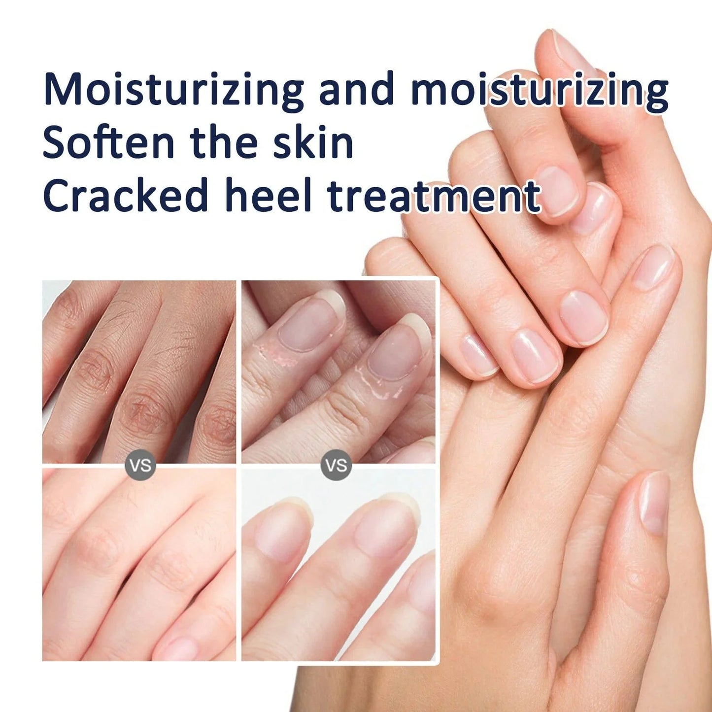 Moisturizing Dry Dead Skin Removal Skin Cream