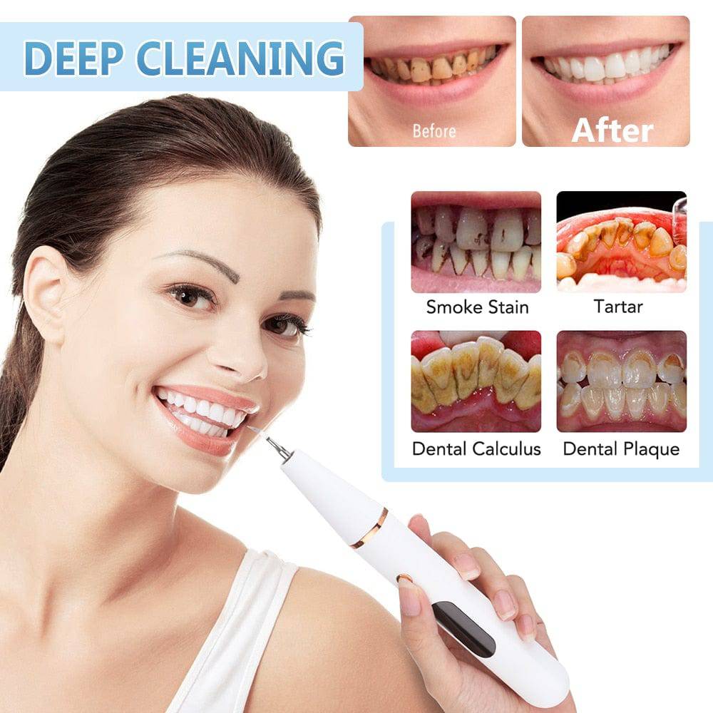 Ultrasonic Dental Scaler Teeth Whitening Wand, Teeth Cleaning Kit - Smart Shop (Online Store for wise shoppers) 