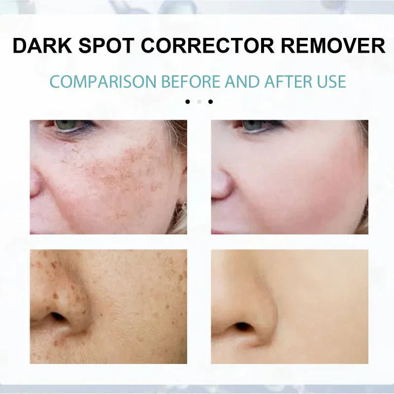 Techanova ™ - Dark Spot Corrector Remover - Smart Shop (Online Store for wise shoppers) )